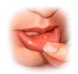 comment soigner ulcere dans la bouche