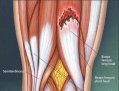 Présentation anatomique d'une déchirure musculaire