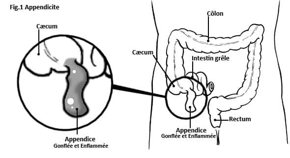 Appendicite aigue, schéma explicatif