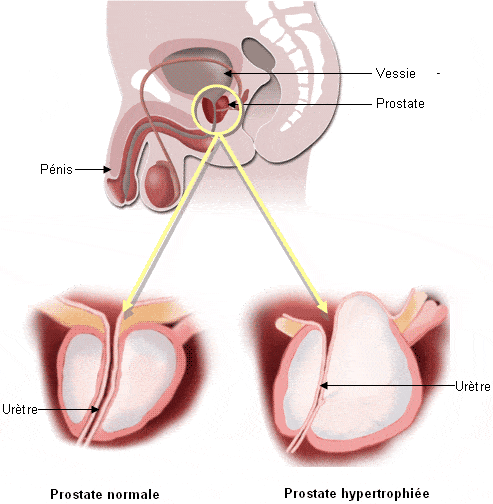 hypertrophie bénigne de la prostate