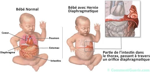Hernie diaphragmatique