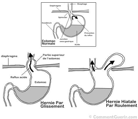 hernie hiatale