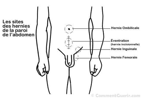 Hernies – Ce que vous devez savoir sur les hernies