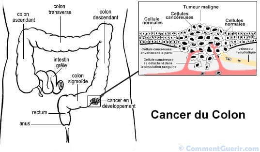 Cancer colon