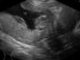 Diagnostic du placenta praevia par l'échographie