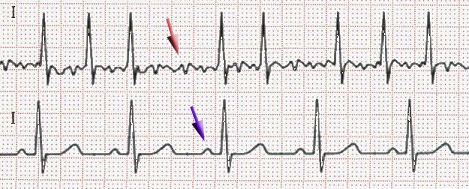 ECG d'une ACFA