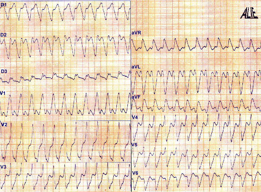 Tachycardie ventriculaire - TV