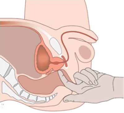 Le toucher rectale peut faire varier le taux de l'antigène prostatique spécifique