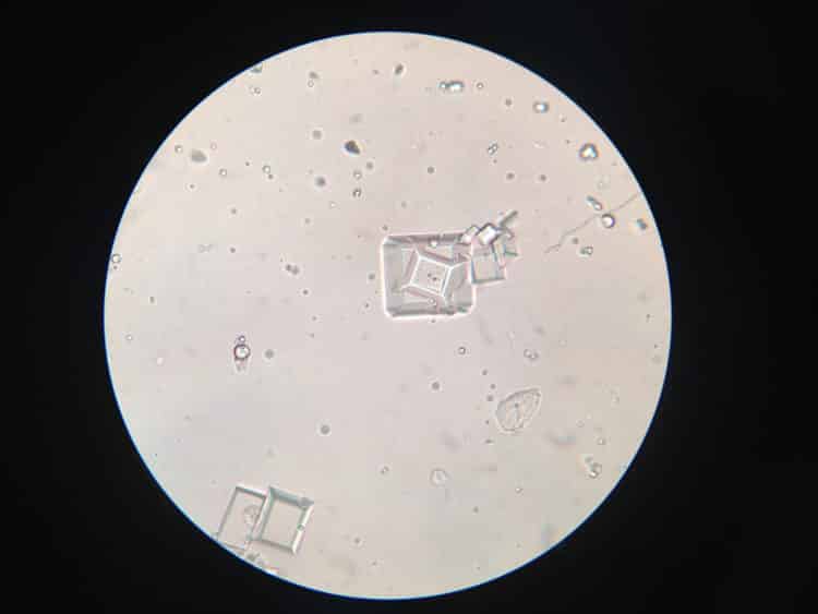 Cristaux dans les urines sous microscope