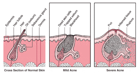Différents types d'Acné