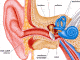 Hypoacousie