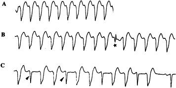 Tachycardie ventriculaire : complexe de fusion (flèche) et de capture (étoile)